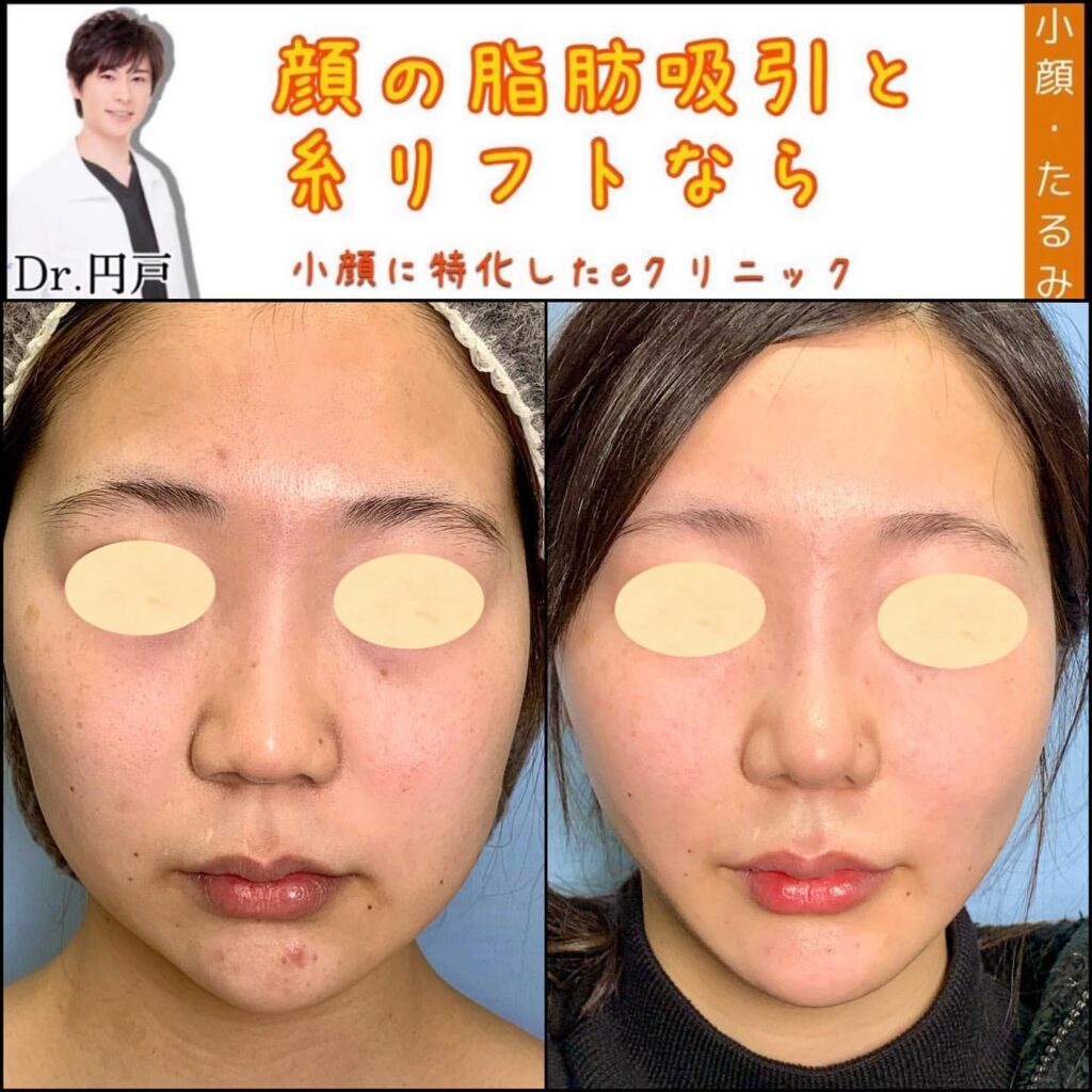 顔の脂肪吸引と糸リフトの症例写真 (3)