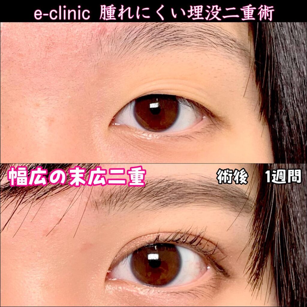 埋没法の症例写真