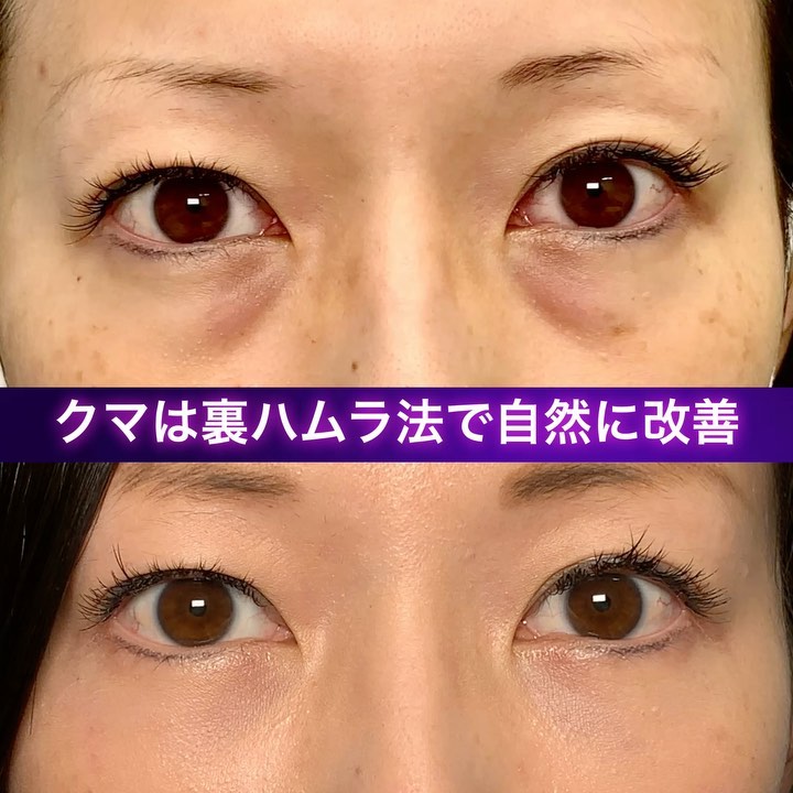 裏ハムラ法を受けた女性の症例