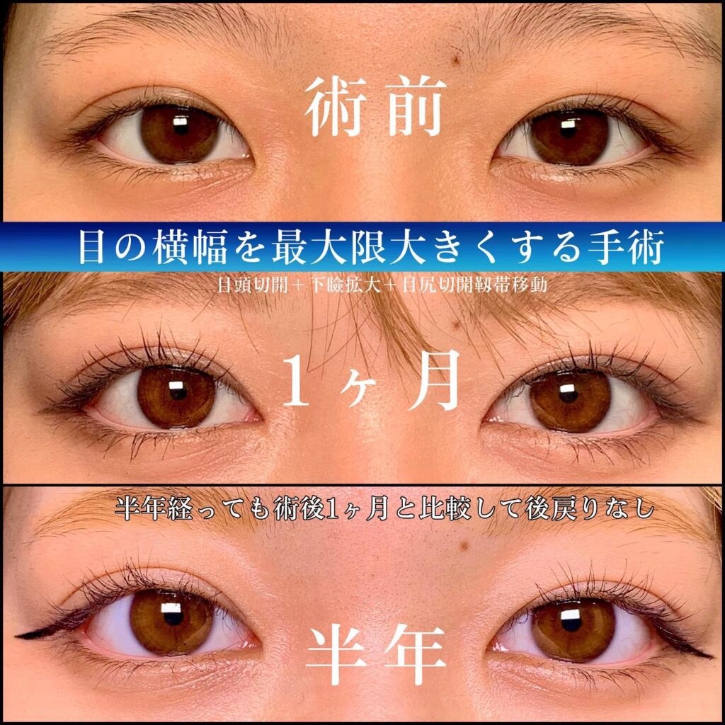 目頭切開とタレ目形成と目尻切開の症例写真 (1)