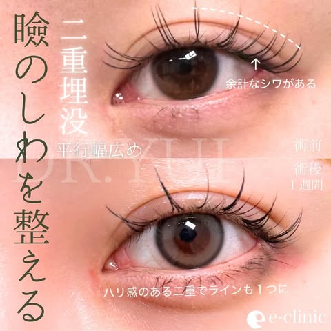 埋没法の症例写真 (4)