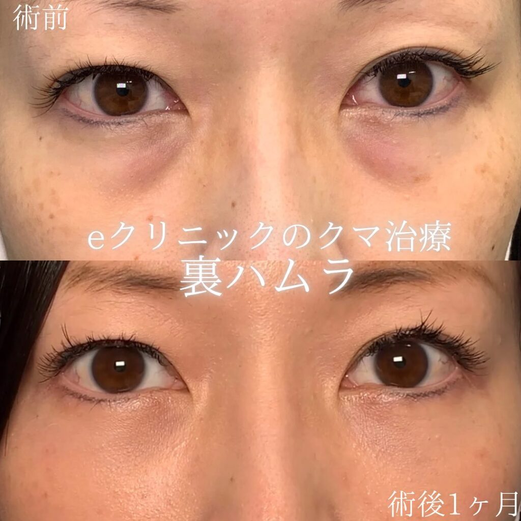 eクリニック札幌院の裏ハムラ症例画像(3)