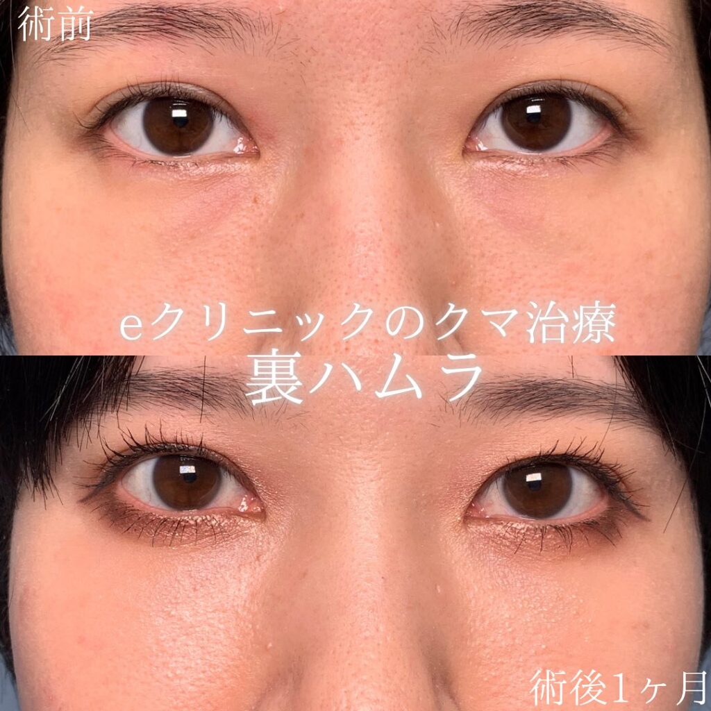 eクリニック札幌院の裏ハムラ症例画像(2)