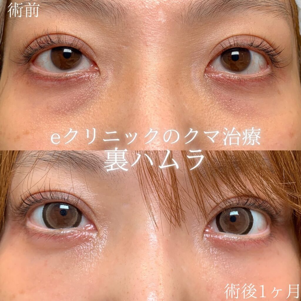 eクリニック札幌院の裏ハムラ症例画像(1)