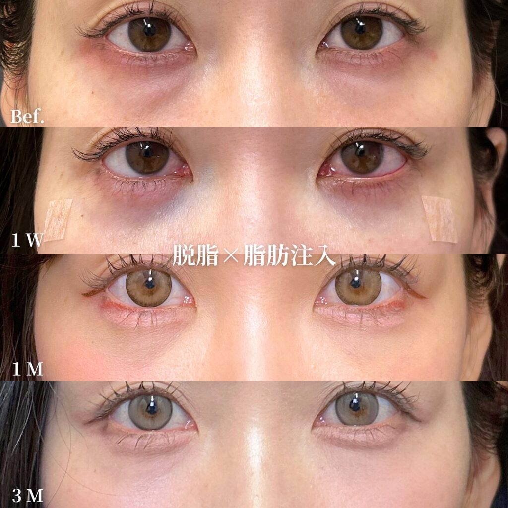 脱脂と脂肪注入の症例写真 (39)