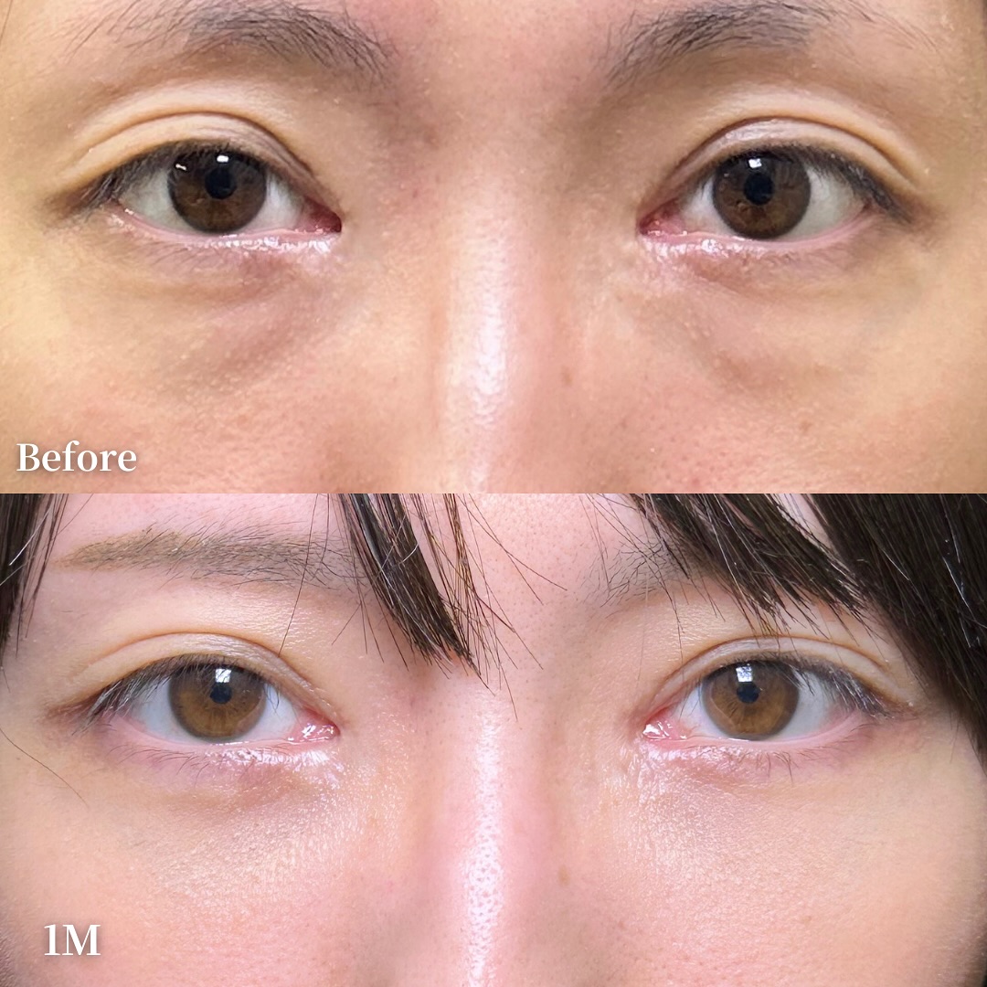 脱脂と脂肪注入でクマを改善した症例写真