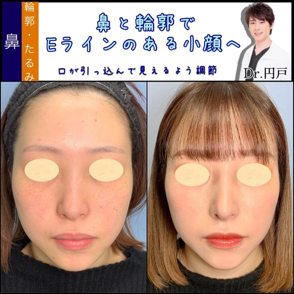 鼻中隔延長と鼻尖形成と軟骨移植と小鼻縮小とプロテーゼと小顔の脂肪吸引とバッカルファットと脂肪注入の症例写真 (1)