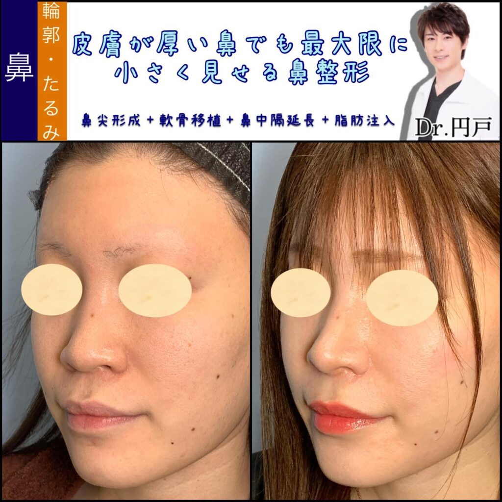 鼻尖形成と軟骨移植と鼻中隔延長と脂肪注入の症例写真 (3)