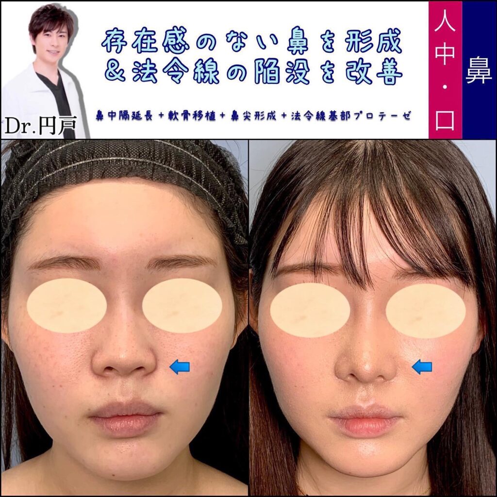 鼻中隔延長と軟骨移植と鼻尖形成と貴族手術の症例 (1)
