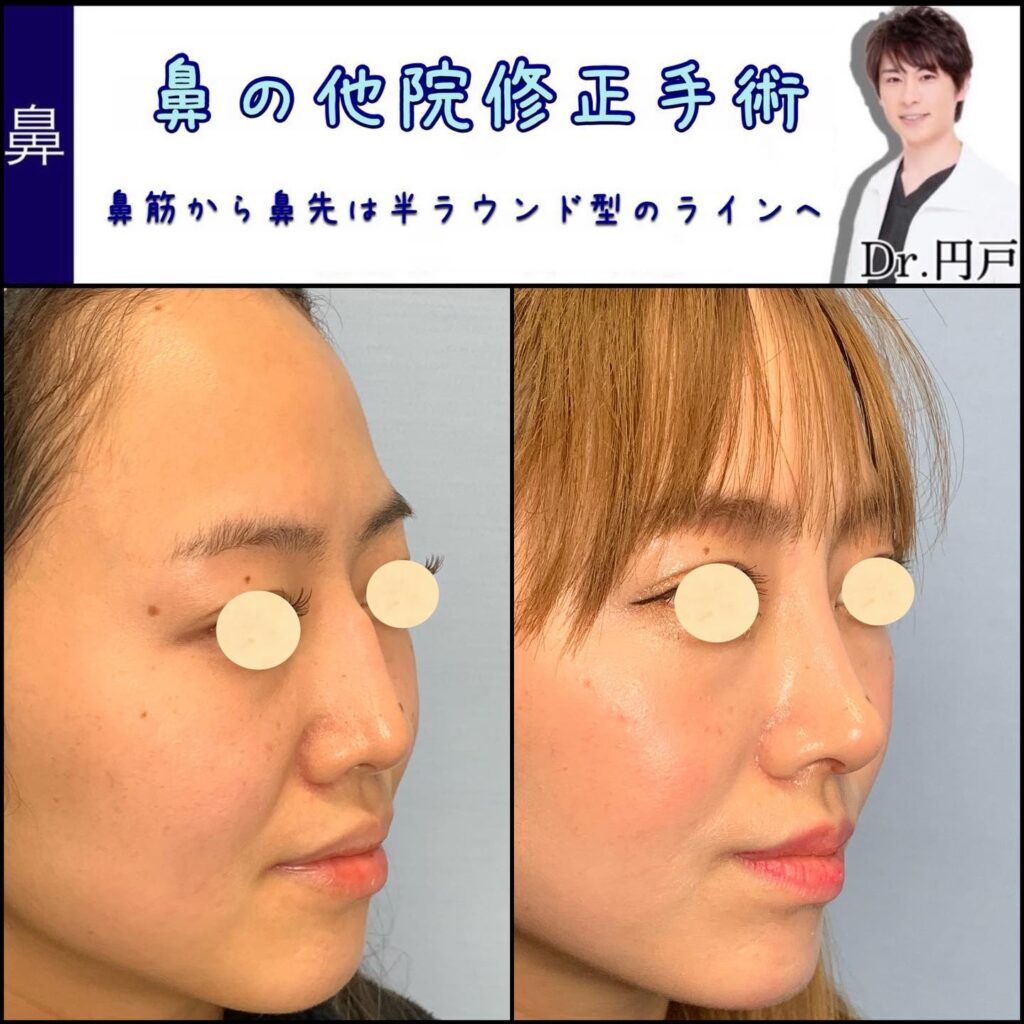 鼻の他院修正の症例写真 (1)