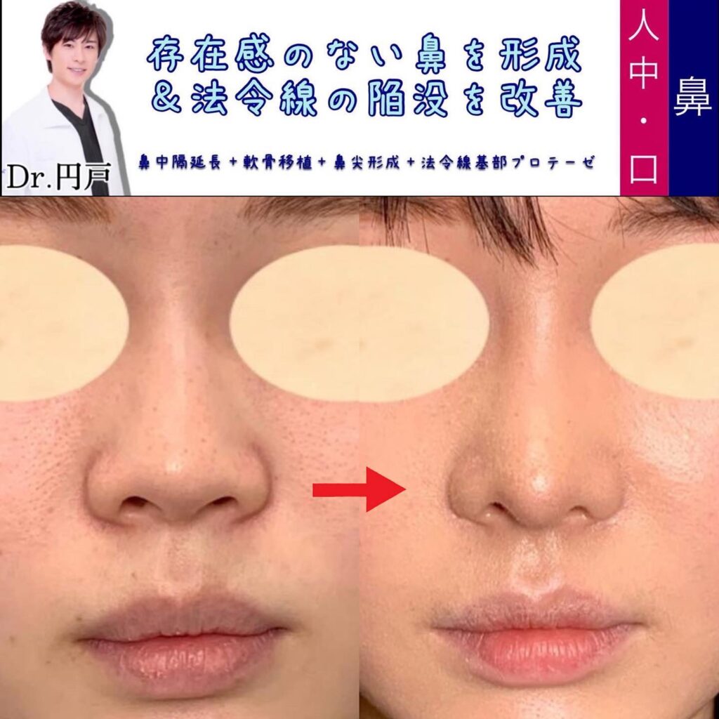 鼻中隔延長と軟骨移植と鼻尖形成と貴族手術の症例 (2)
