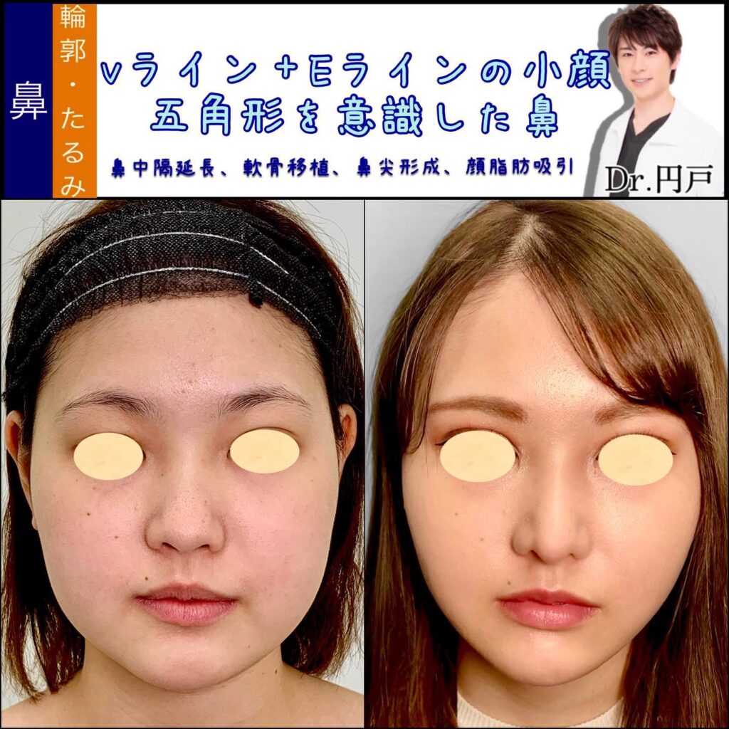 鼻中隔延長と軟骨移植と鼻尖形成と脂肪吸引の症例写真 (2)