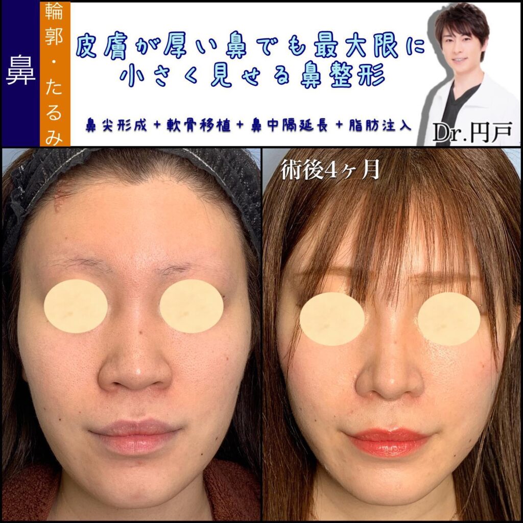 鼻尖形成と軟骨移植と鼻中隔延長と脂肪注入の症例写真 (2)