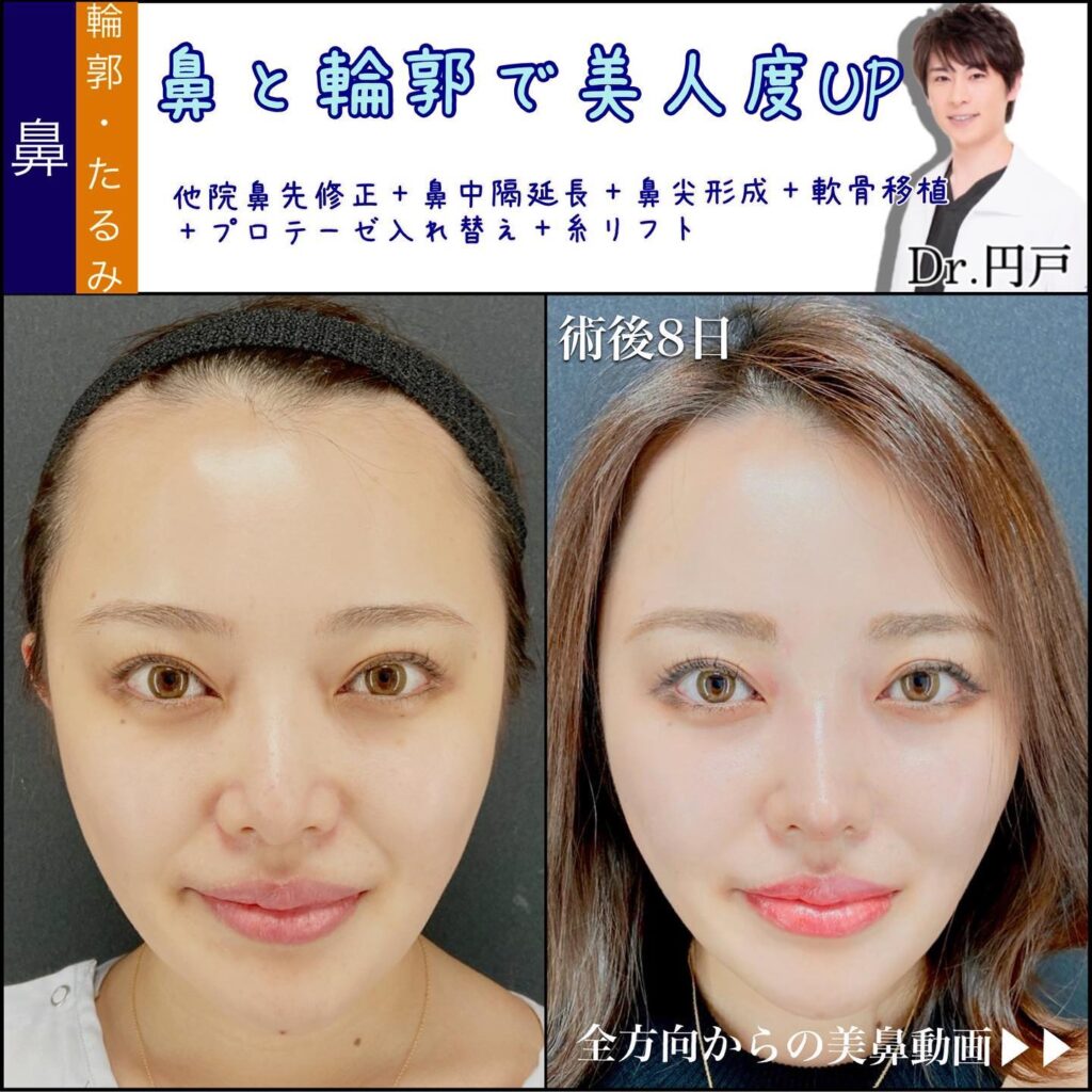 他院の鼻修正と鼻中隔延長と鼻尖形成と軟骨移植とプロテーゼの入れ替えと糸リフトの症例写真