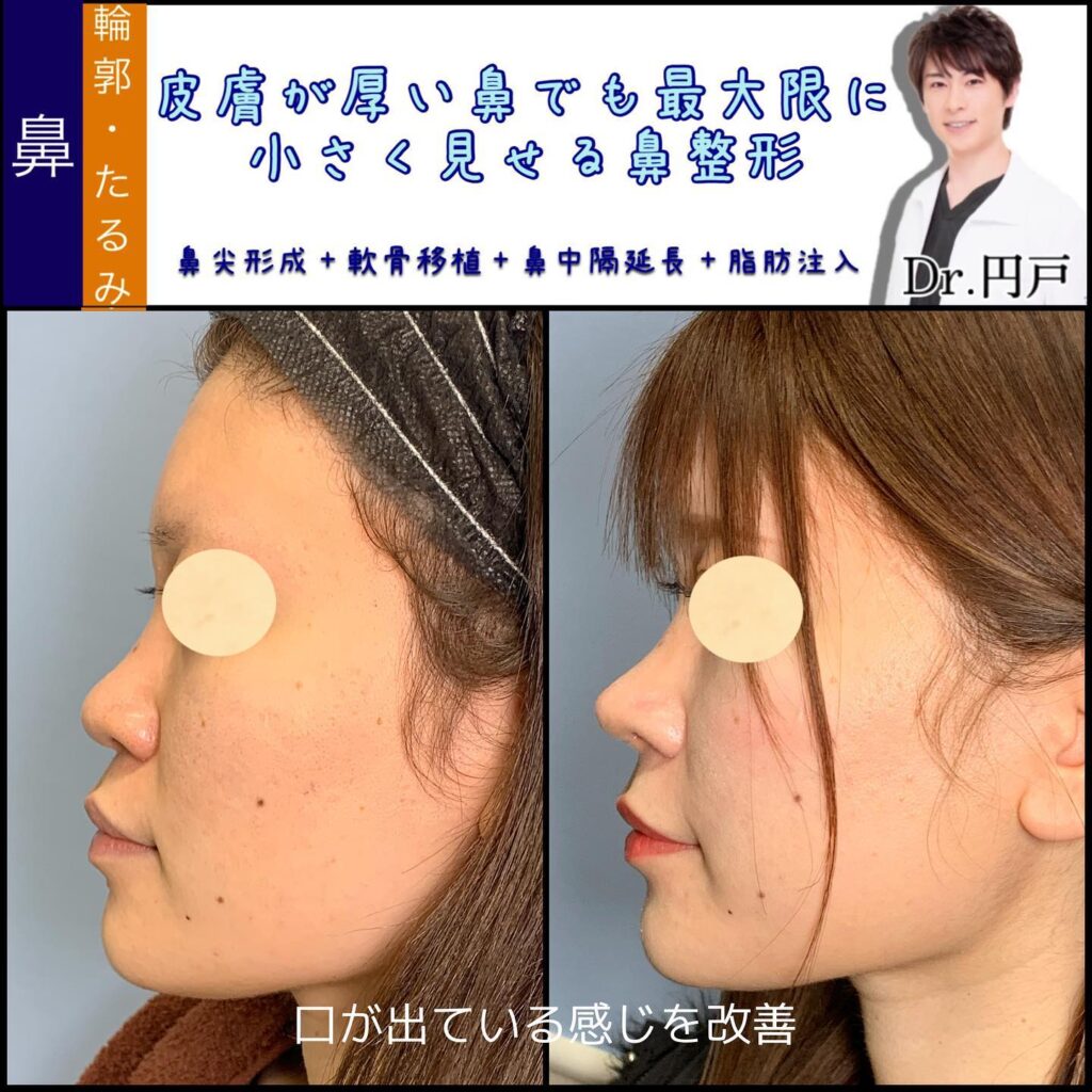 鼻中隔延長と鼻尖形成と軟骨移植と小鼻縮小とプロテーゼと小顔の脂肪吸引とバッカルファットと脂肪注入の症例写真 (2)