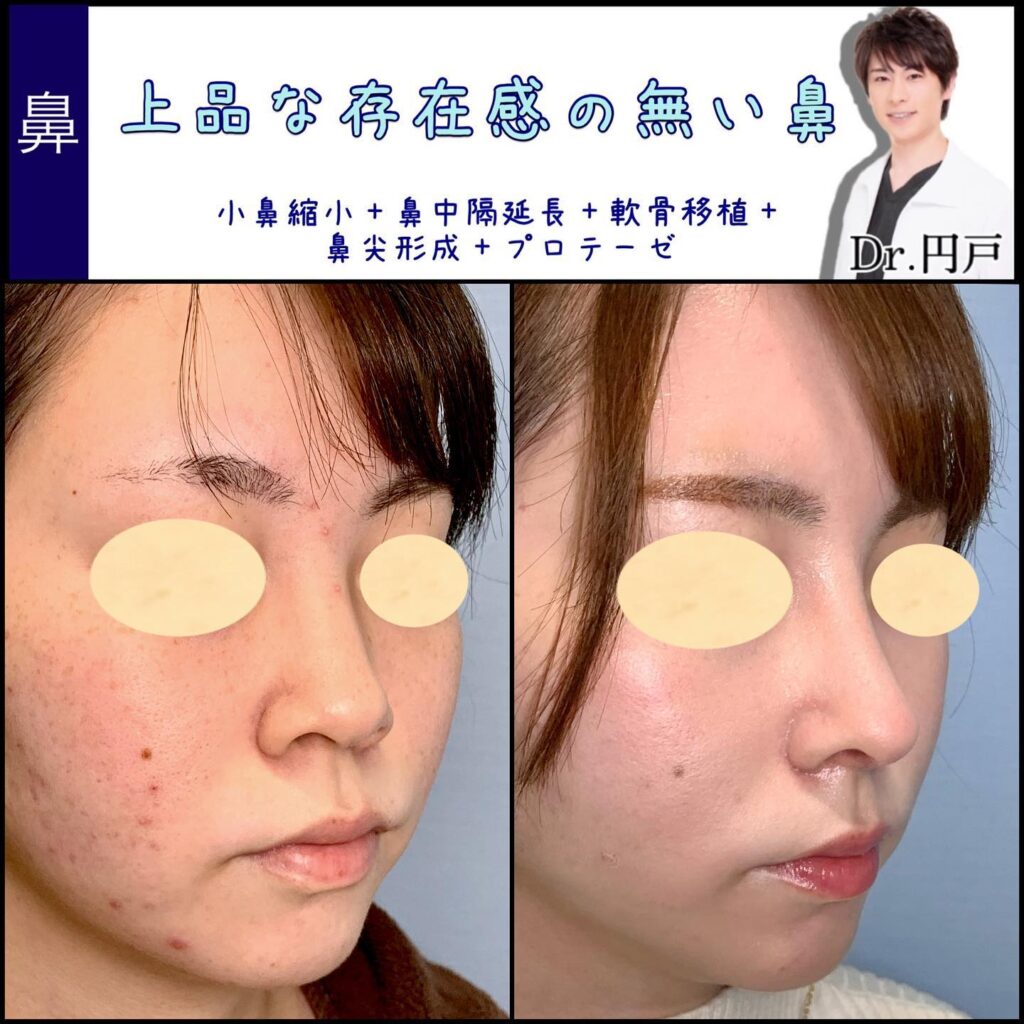 小鼻縮小と鼻中隔延長と軟骨移植と鼻尖形成と鼻のプロテーゼの症例写真 (1)