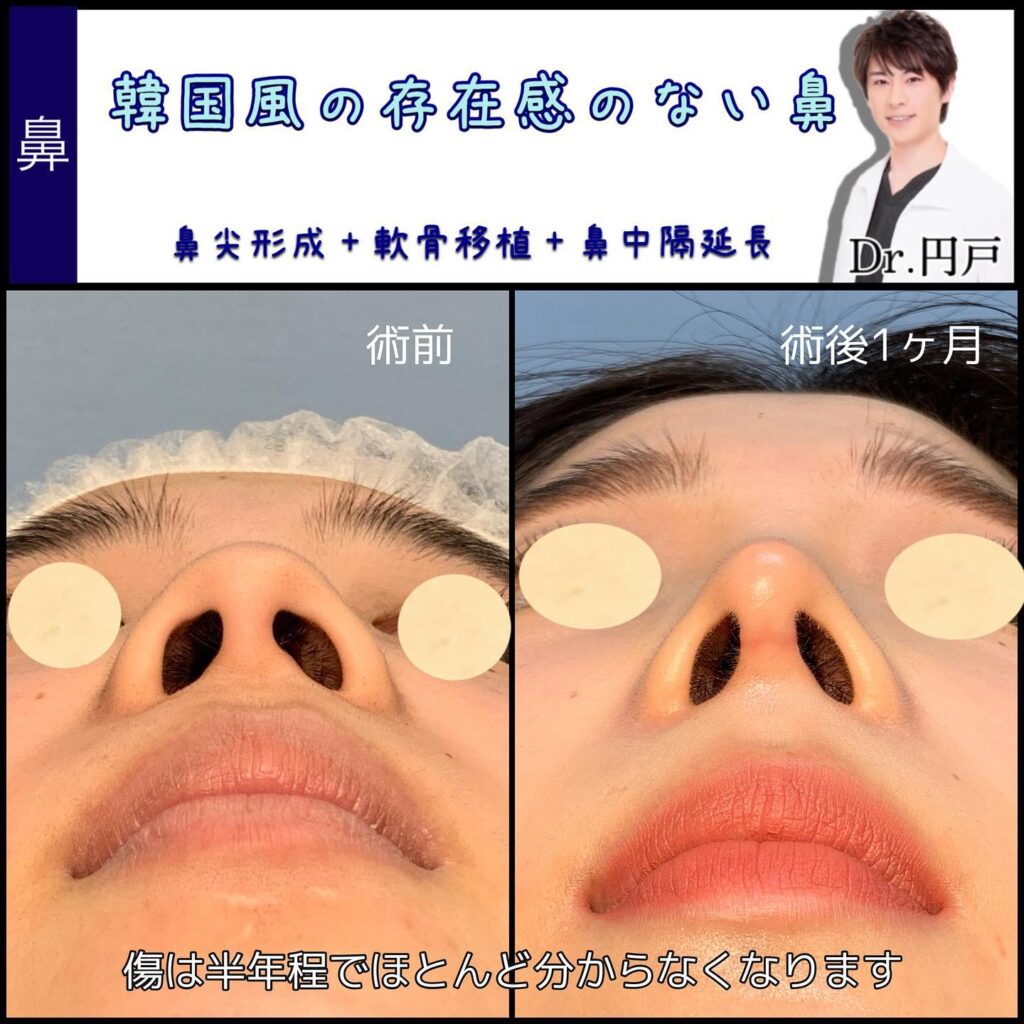 鼻尖形成と軟骨移植と鼻中隔延長の症例写真 (3)