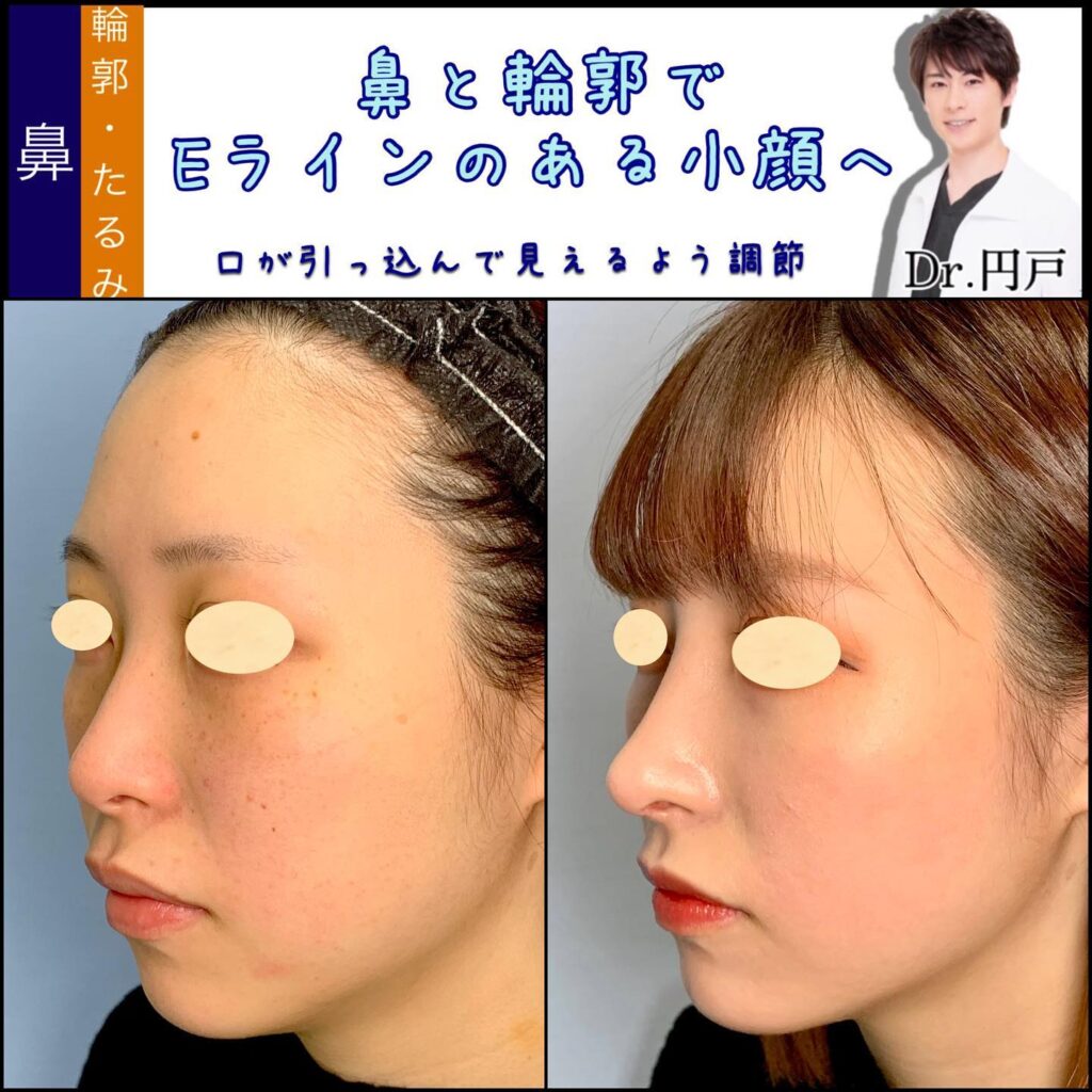 鼻中隔延長と鼻尖形成と軟骨移植と小鼻縮小とプロテーゼと小顔の脂肪吸引とバッカルファットと脂肪注入の症例写真 (2)