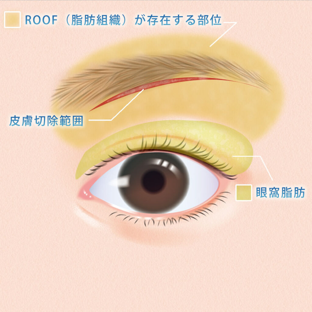 眉下切開の切開する範囲の図解