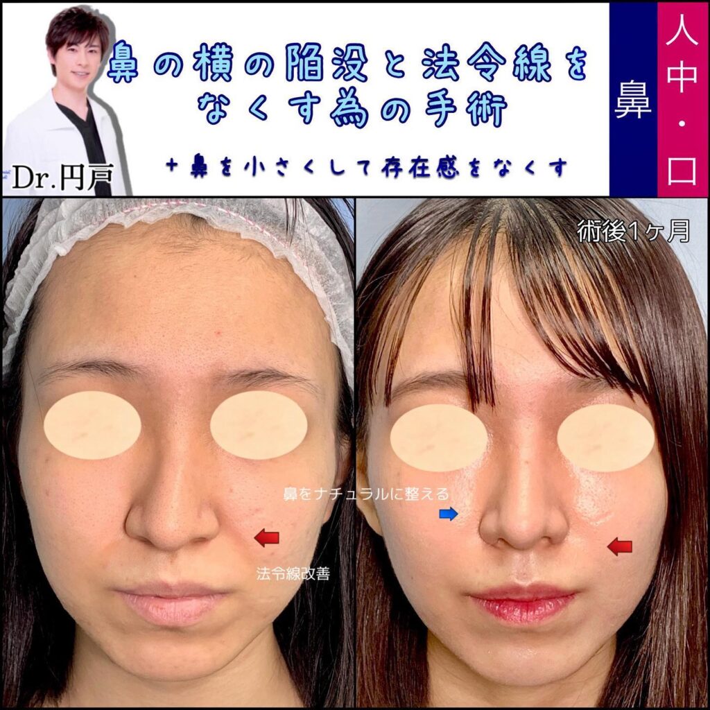 貴族手術（人工真皮） の症例写真 (2)