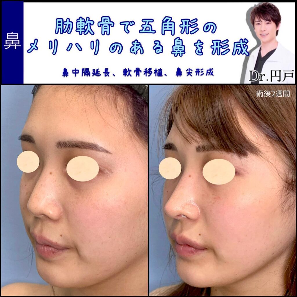 鼻中隔延長と軟骨移植と鼻尖形成の症例写真 (1)