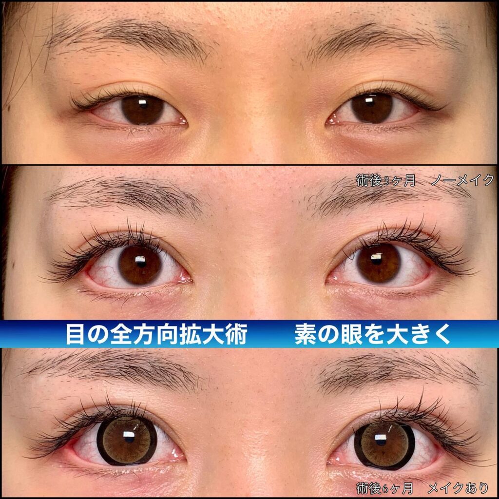 全切開と目頭切開とタレ目形成と目尻切開を同時に行った3ヶ月後と6ヶ月後の症例