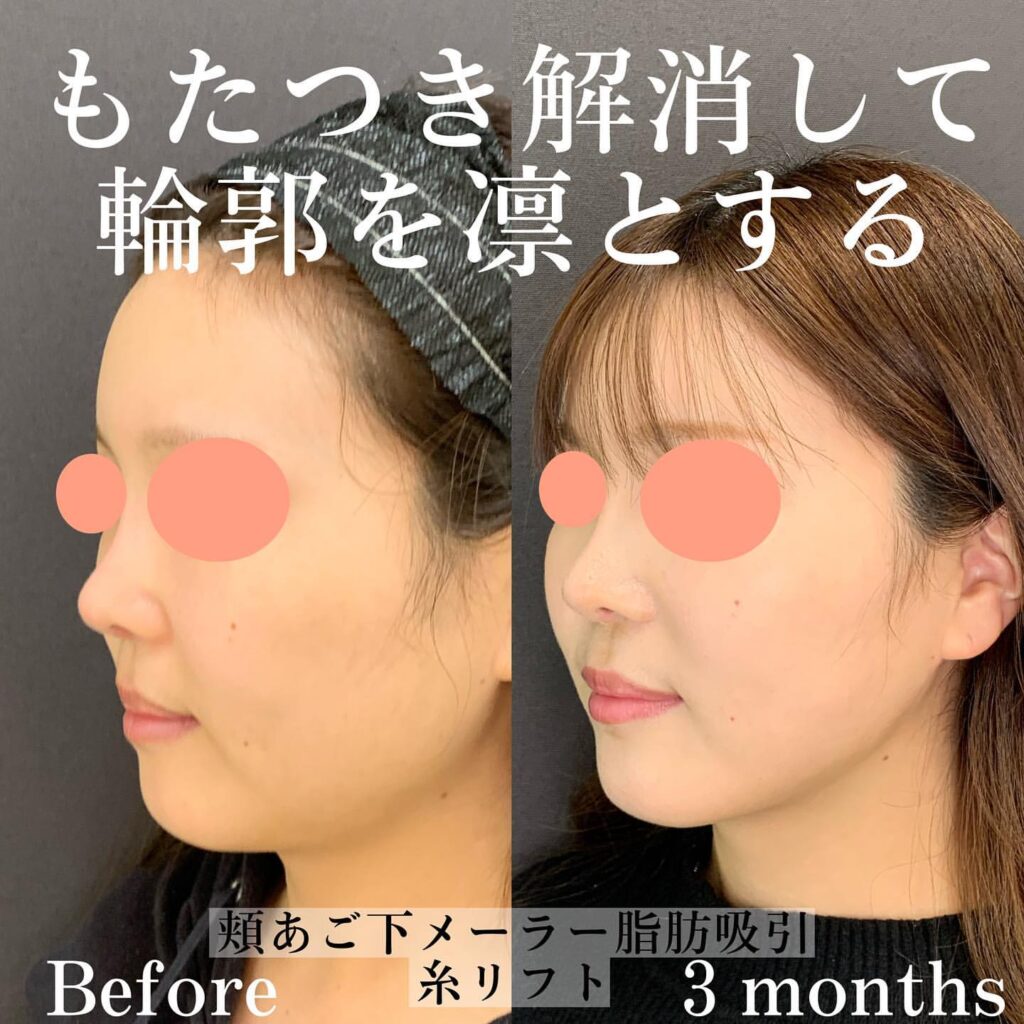 eclinicc札幌院の脂肪吸引症例写真