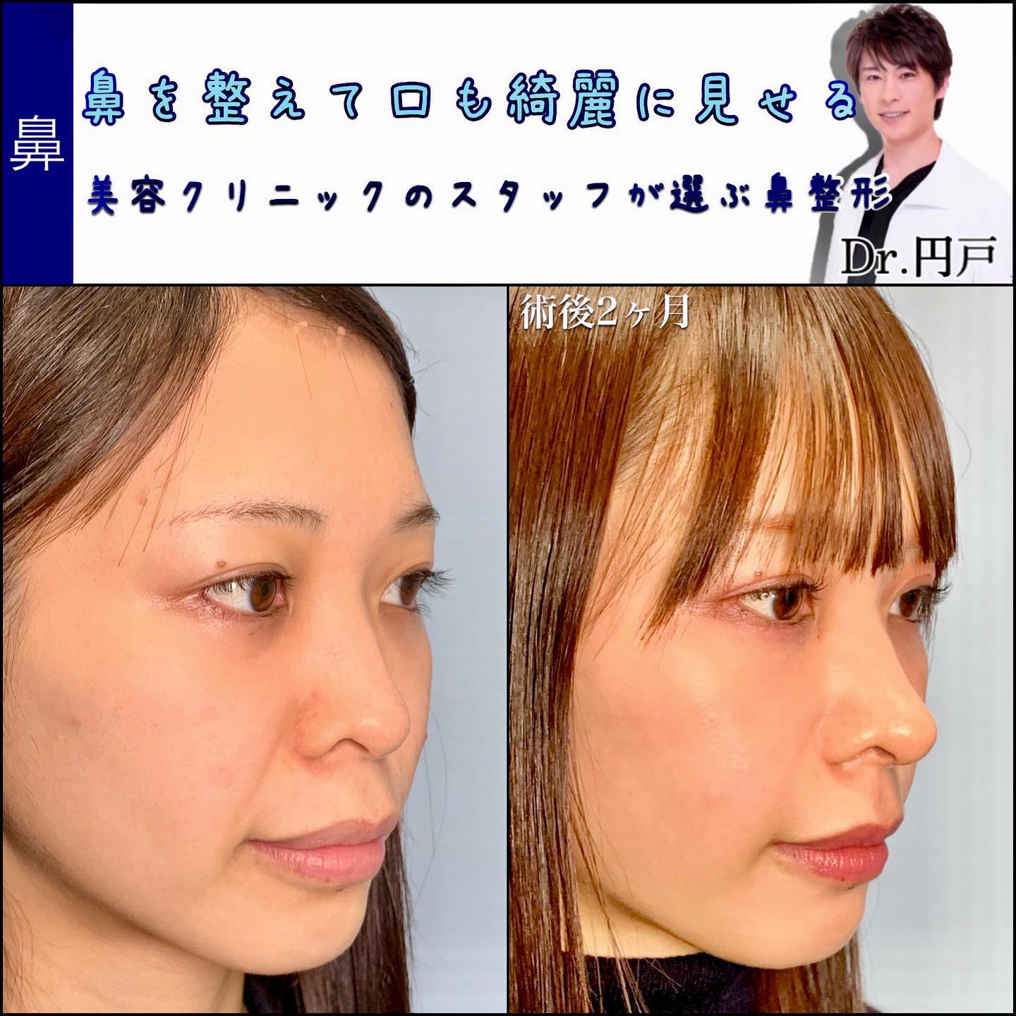 鼻尖形成と軟骨移植と鼻中隔延長と額と法令線脂肪注入の症例写真