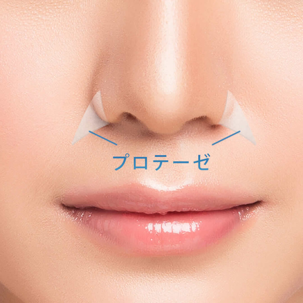 貴族手術の図解