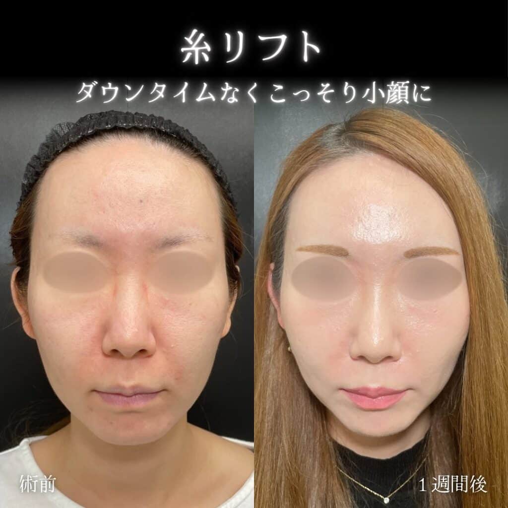 eclinic札幌院の糸リフト症例写真