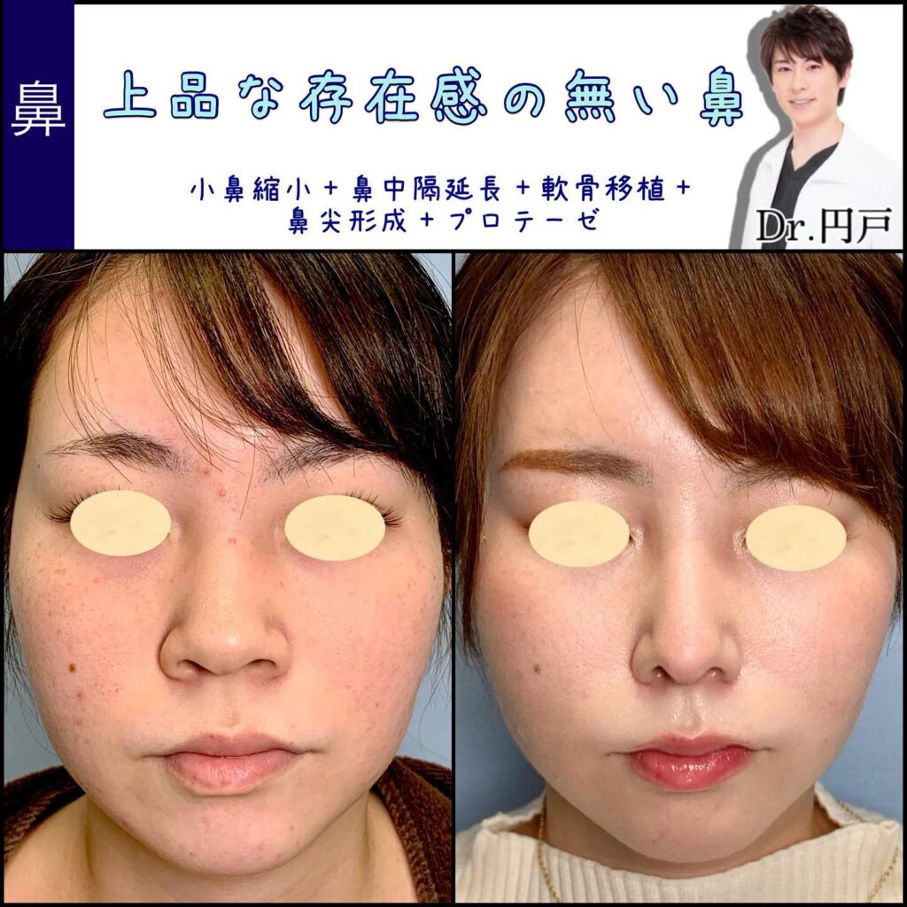 小鼻縮小と鼻中隔延長と軟骨移植と鼻尖形成と鼻のプロテーゼの症例写真 (2)