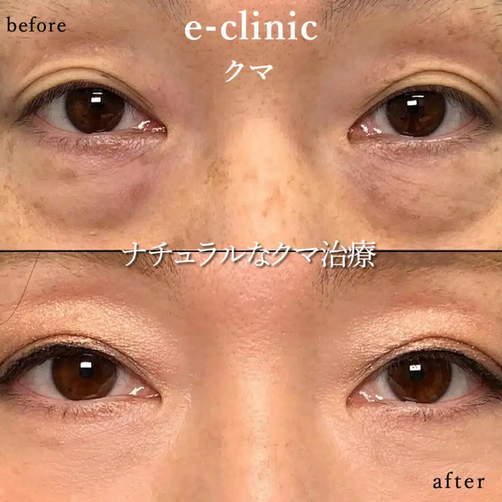 eclinic札幌院の表ハムラの症例画像(3)