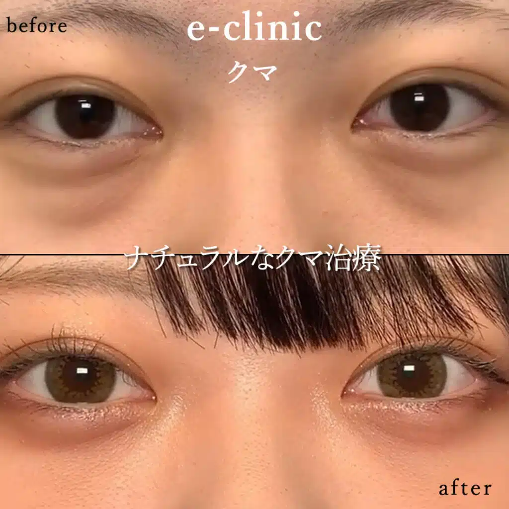 eclinic札幌院の表ハムラの症例画像(2)