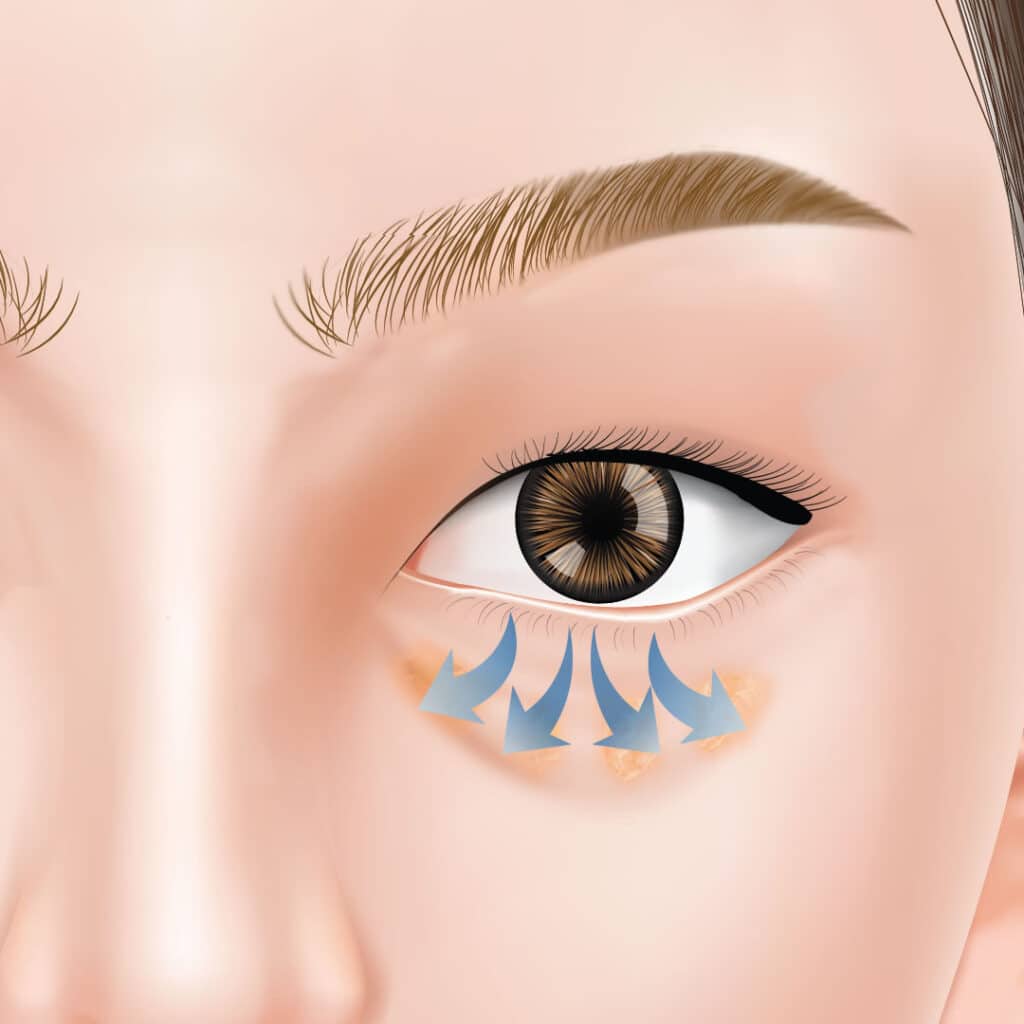 眼窩脂肪再配置