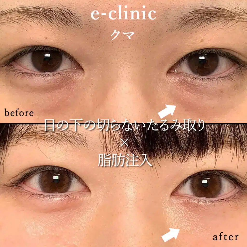 eclinic札幌院の表ハムラの症例画像(1)