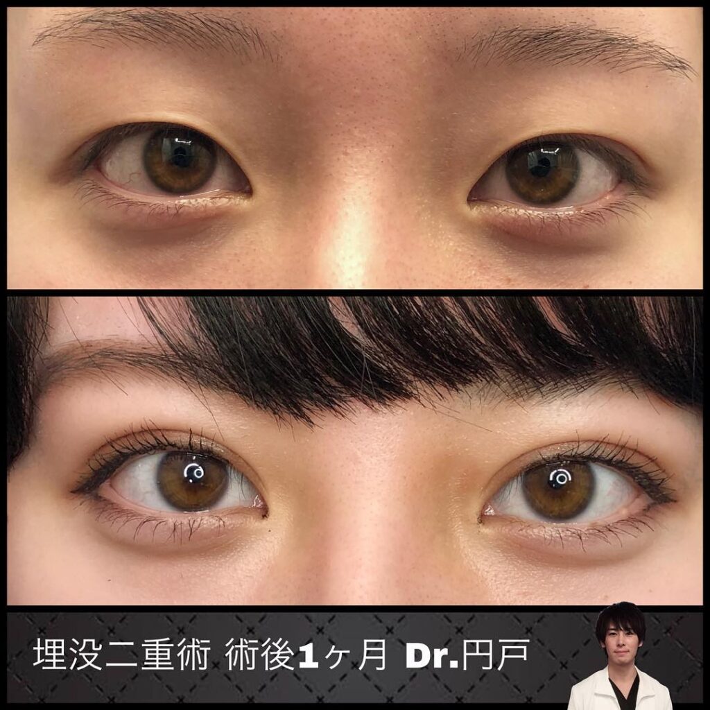 埋没法1ヶ月後の症例