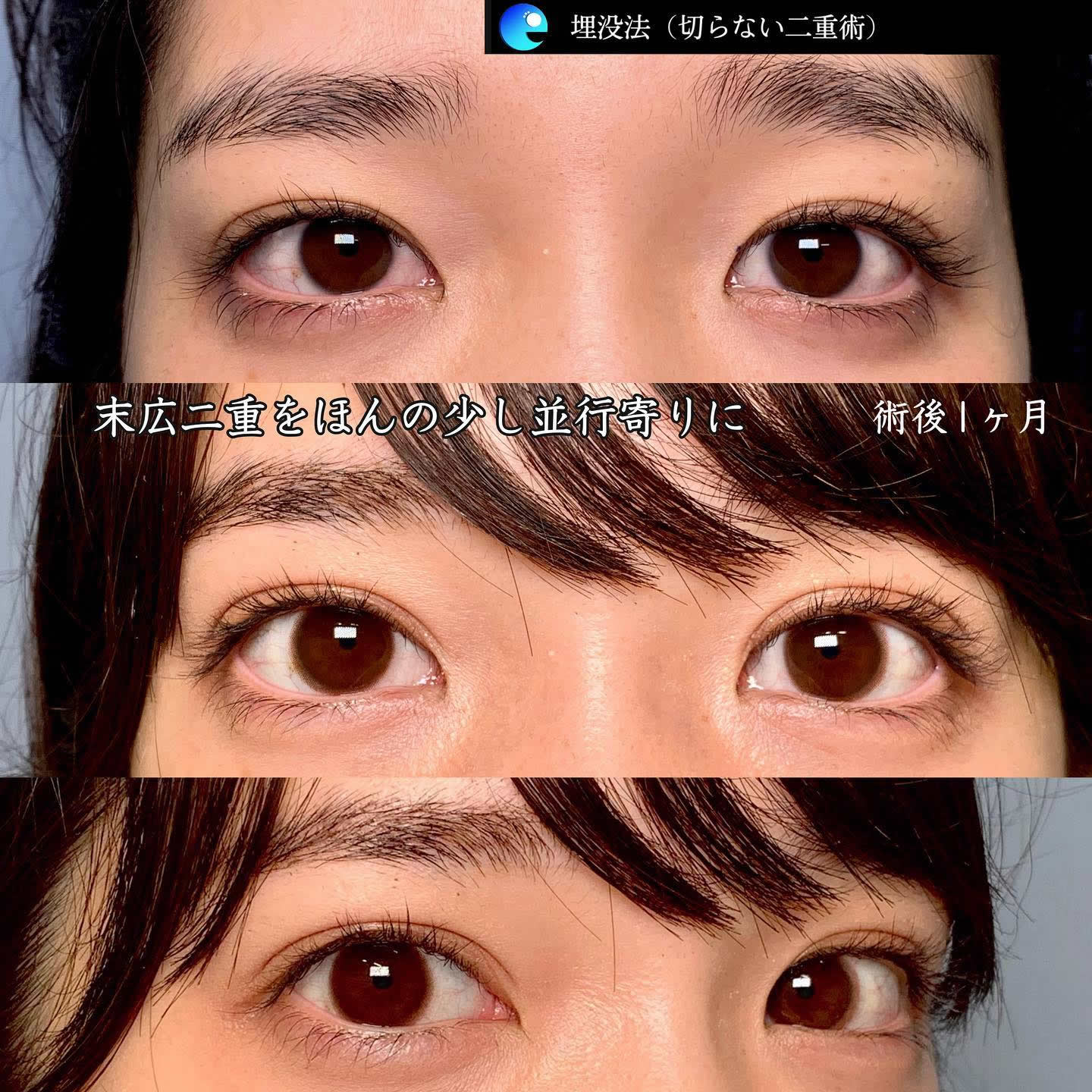 末広型の二重を少し平行型にした埋没法の症例写真