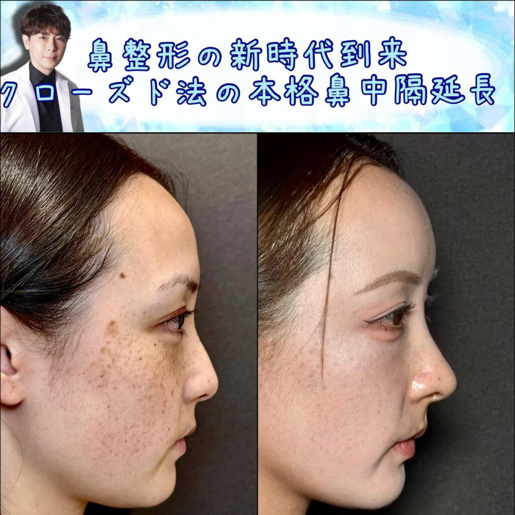 横から見た傷がない鼻中隔延長の症例写真