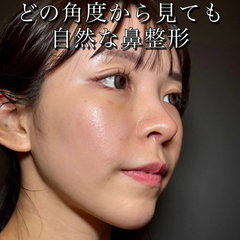 クローズド法の鼻尖形成と軟骨移植の10日後の自然な鼻の状態