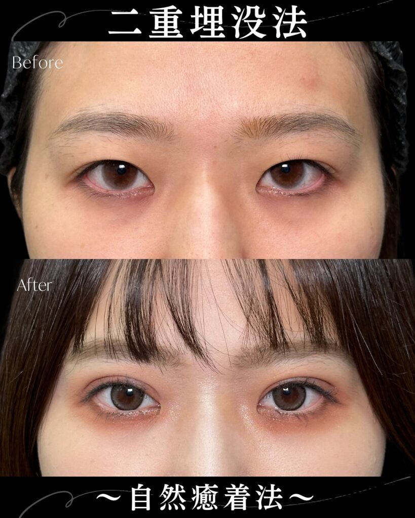 自然癒着法の症例写真