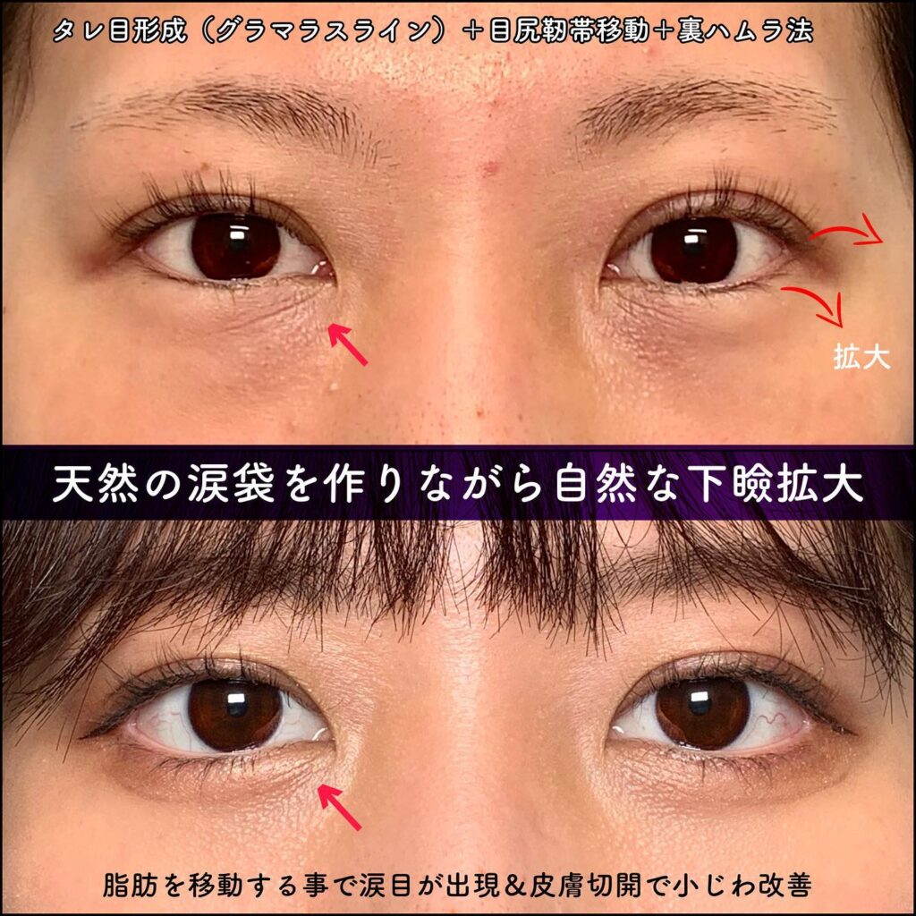 タレ目形成と目尻靭帯移動と裏ハムラ法の症例写真