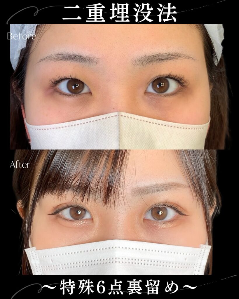 特殊6点留めの症例写真 (2)