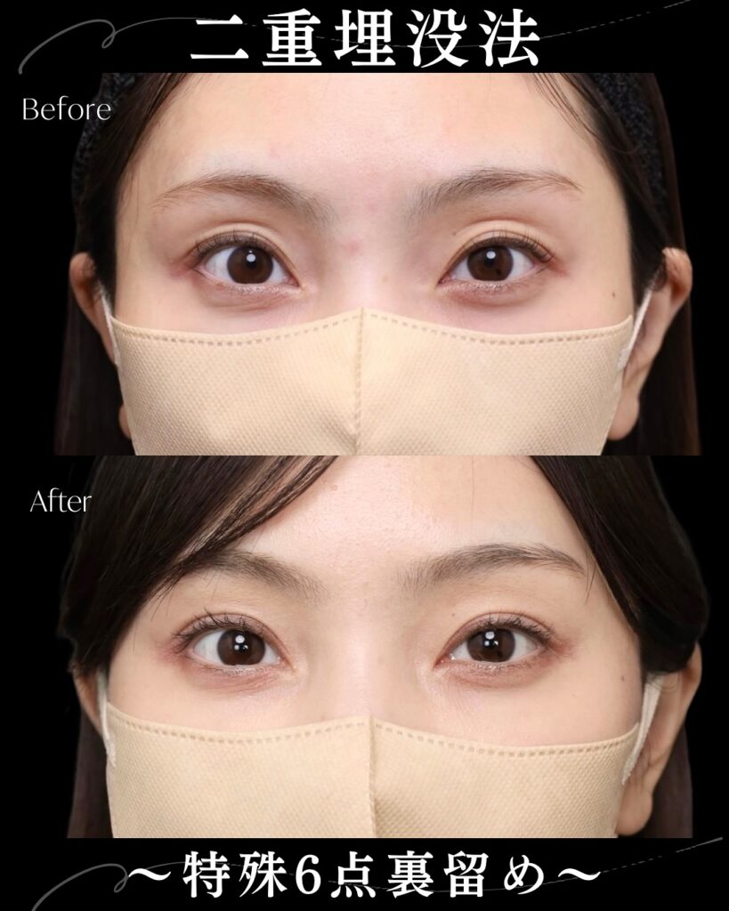 特殊6点留めの症例写真