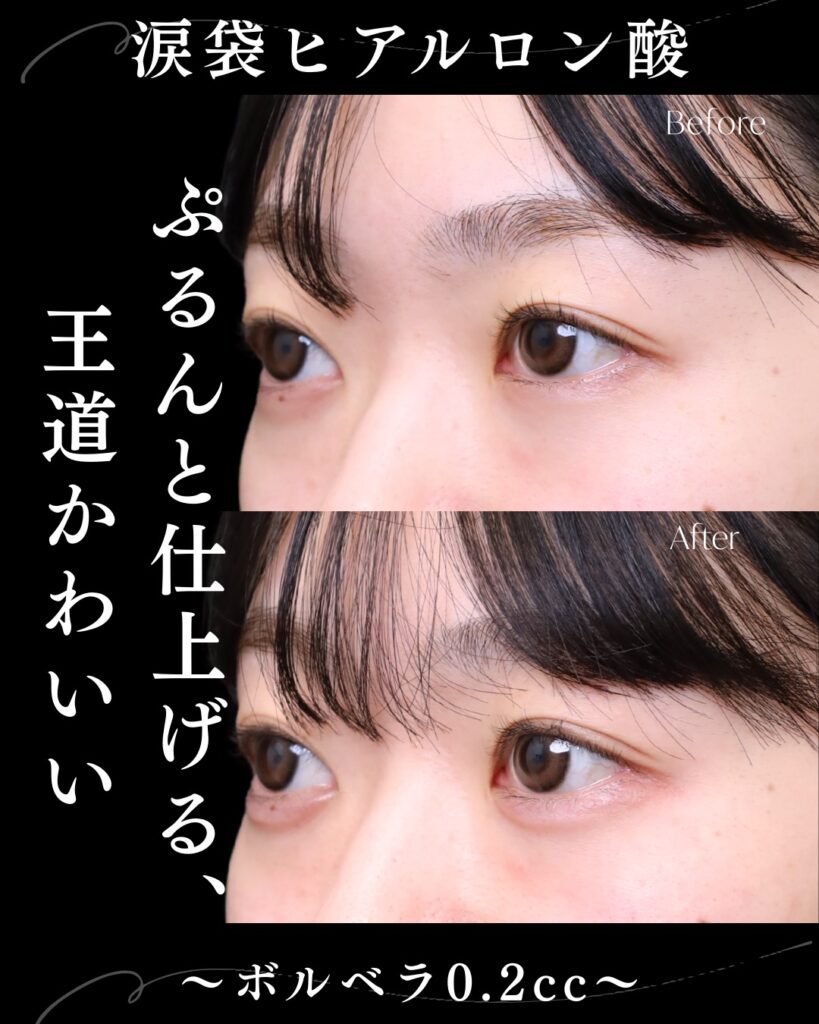 涙袋のヒアルロン酸の症例写真