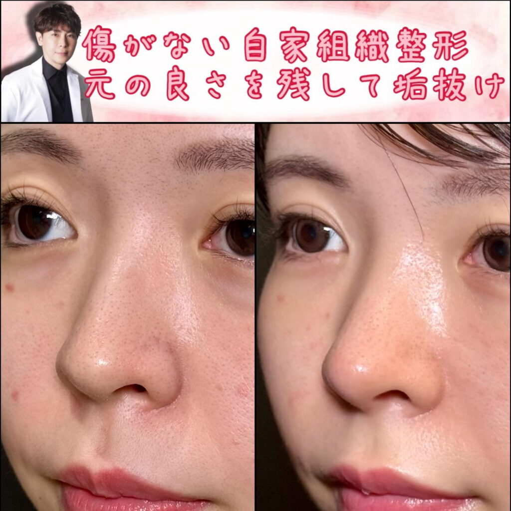 斜め右から見たクローズド法の鼻尖形成と軟骨移植の症例写真