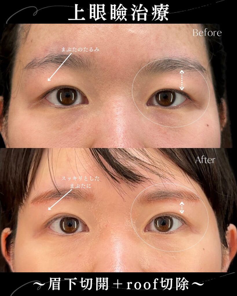 眉下切開の症例写真