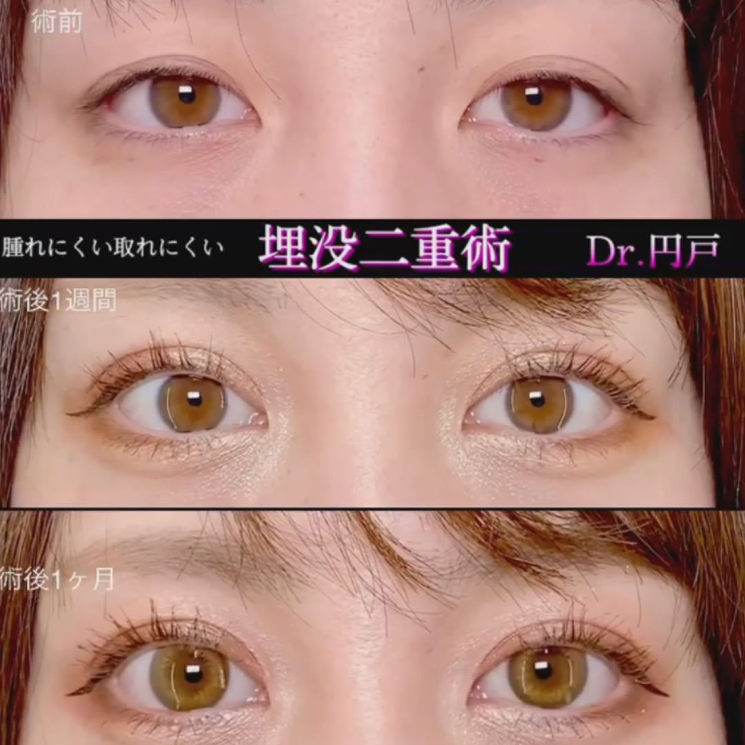 埋没法の1週間後と1か月後の症例写真