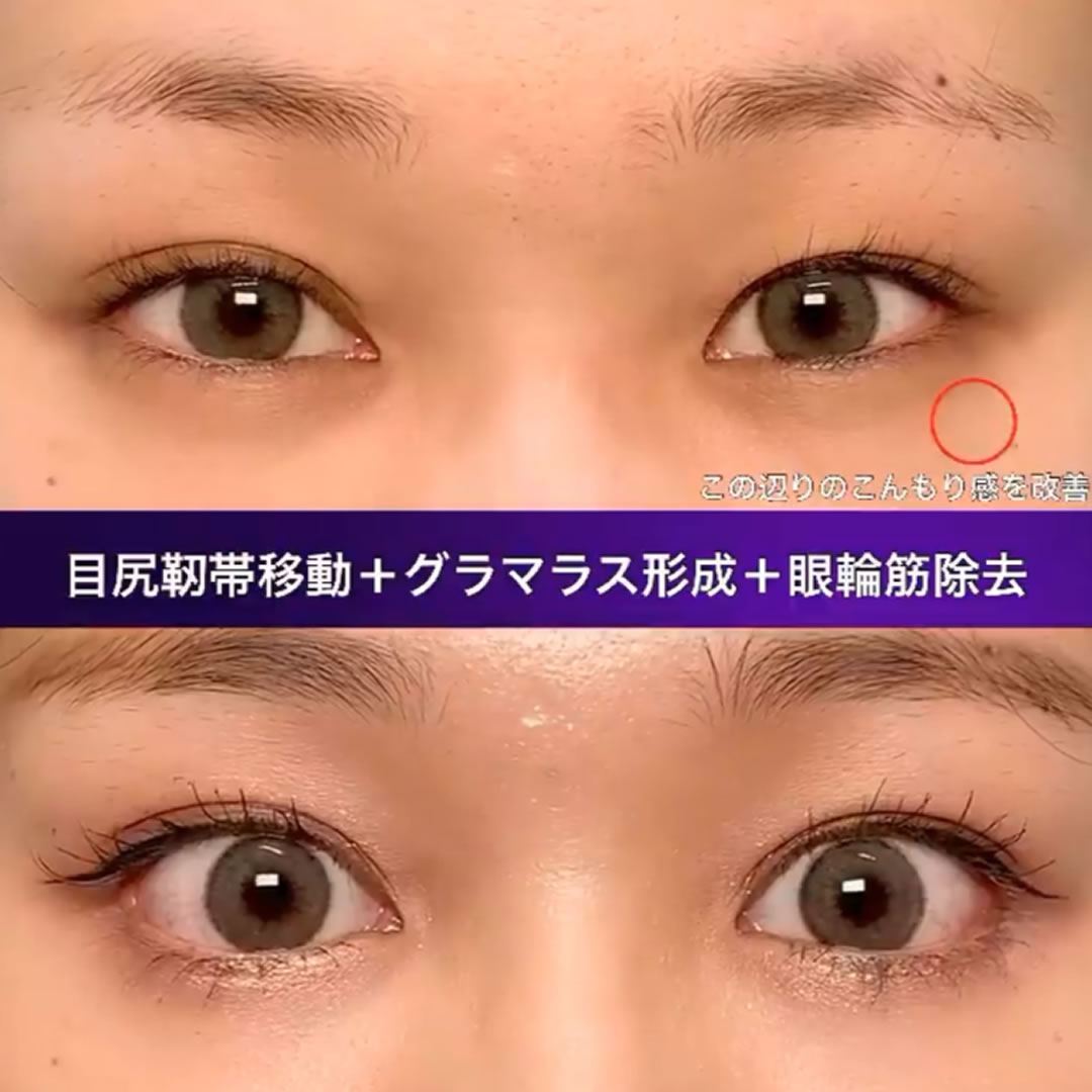 31 目尻靭帯移動とグラマラスライン形成と眼輪筋除去の症例写真
