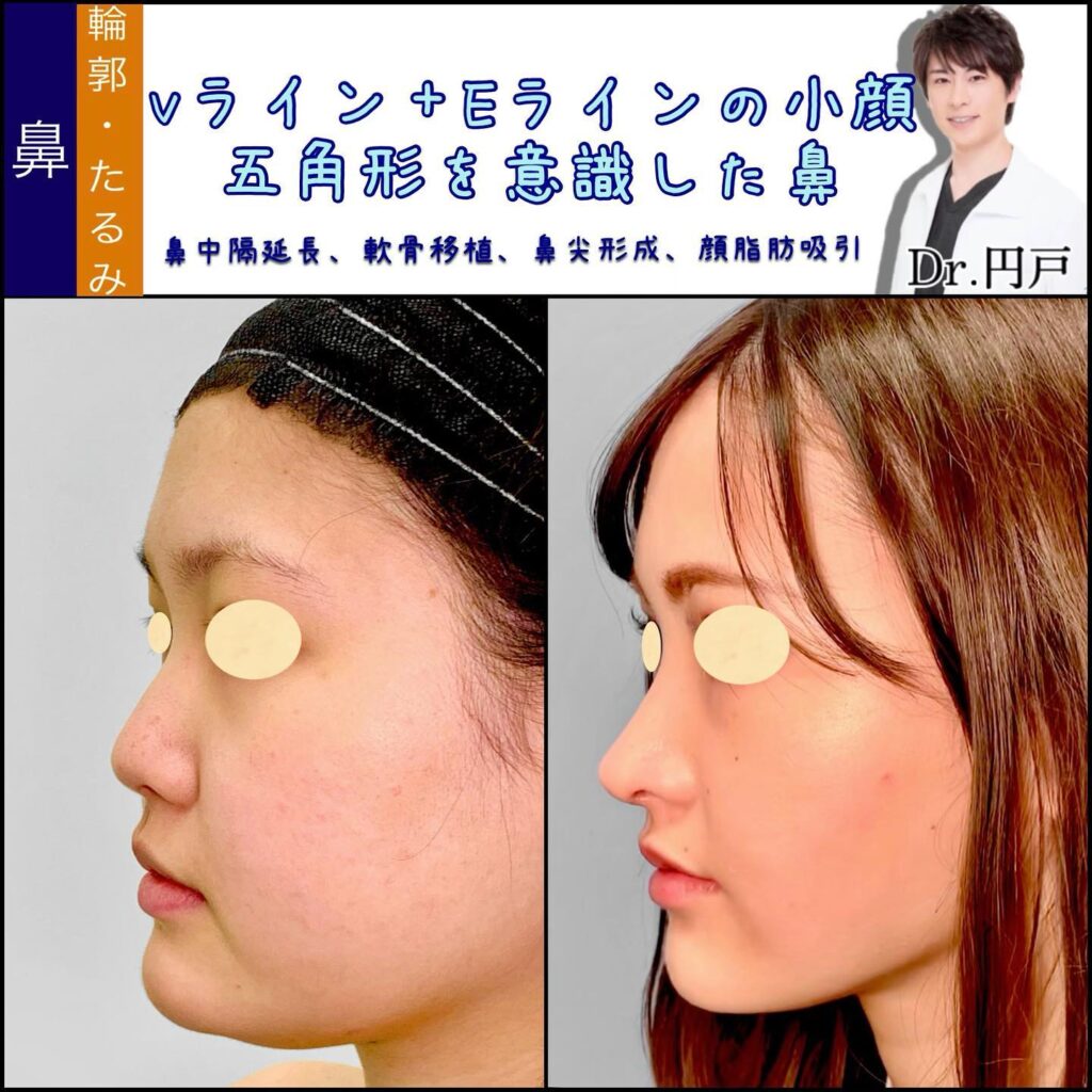 鼻中隔延長と軟骨移植と鼻尖形成と小顔脂肪吸引の症例写真 (1)