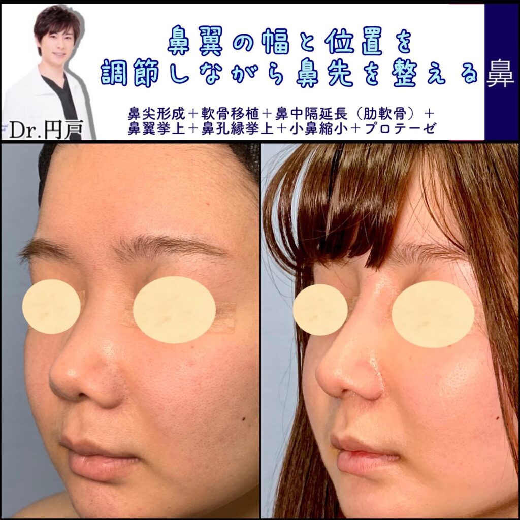 鼻尖形成と軟骨移植と鼻中隔延長と鼻翼挙上と鼻孔縁挙上と小鼻縮小とプロテーゼの症例写真 (2)
